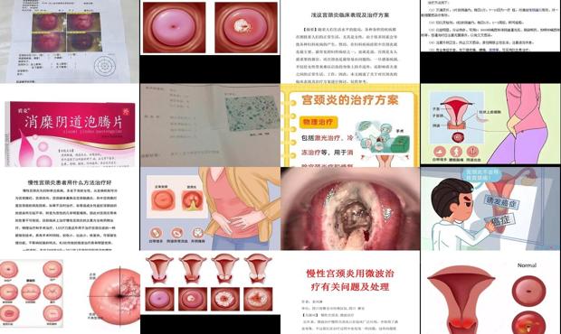 汕头治疗宫颈炎