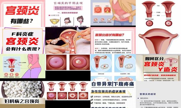 汕头宫颈炎的症状