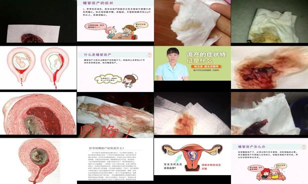 汕头流产的症状