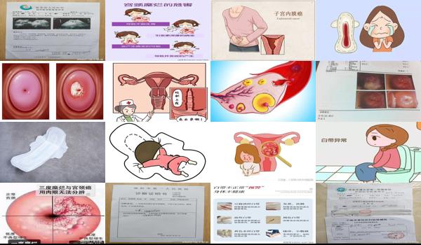 宫颈糜烂会有褐色分泌物吗? - 汕头宫颈糜烂会有褐色分泌物吗