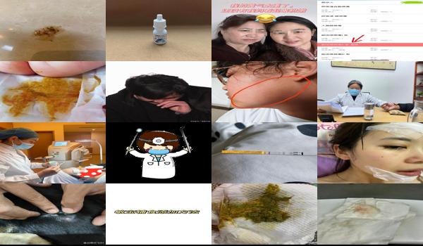 宫颈刮片后第三天有鲜红的血 - 汕头做完宫颈刮片第三天还有血丝