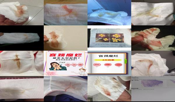 宫颈糜烂分泌物带血丝 - 汕头宫颈糜烂白带有血丝