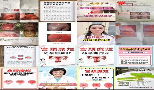 说是宫颈糜烂 - 汕头宫颈糜烂是常见病