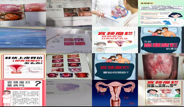 怀孕四个月重度宫颈糜烂怎么办 - 汕头怀孕四个多月,中度宫颈糜烂严重吗