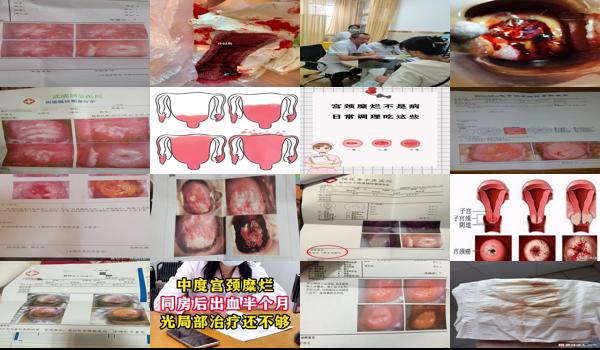 汕头宫颈糜烂修复手术十天出血正常吗多少钱 - 汕头宫颈糜烂修复手术十天出血正常吗