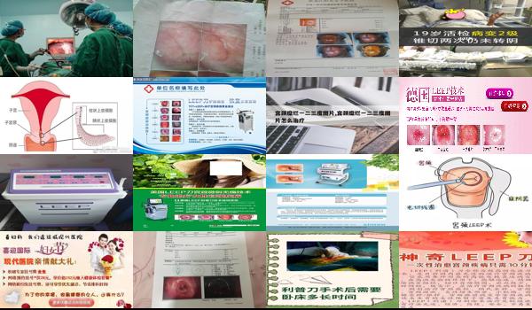 宫颈糜烂做利普刀多久可以同房 - 汕头宫颈糜烂做利普刀后要休息几天
