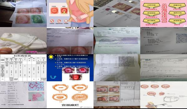 宫颈炎轻度会宫颈*吗 - 汕头轻度宫颈炎会恶化