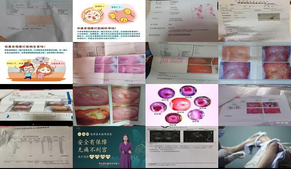 做了宫颈糜烂*手术,影响顺生吗? - 汕头宫颈糜烂做完*后怀孕会复发吗