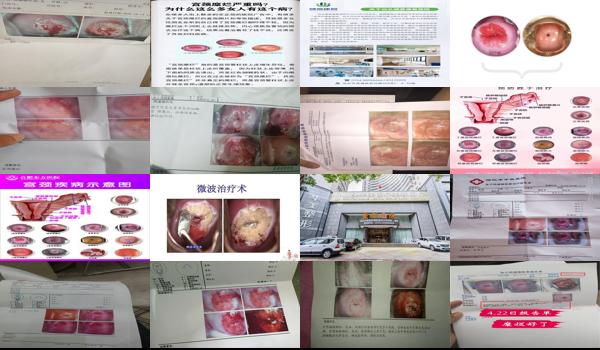 汕头哪个医院治疗宫颈*好 - 汕头宫颈糜烂那个医院*