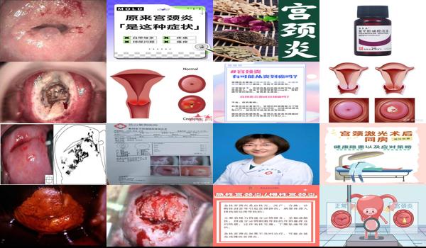 汕头宫颈炎激光治疗医院 - 汕头宫颈炎激光治疗