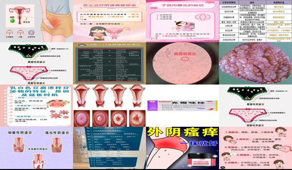 汕头妇科真菌感染医院 - 汕头妇科真菌感染