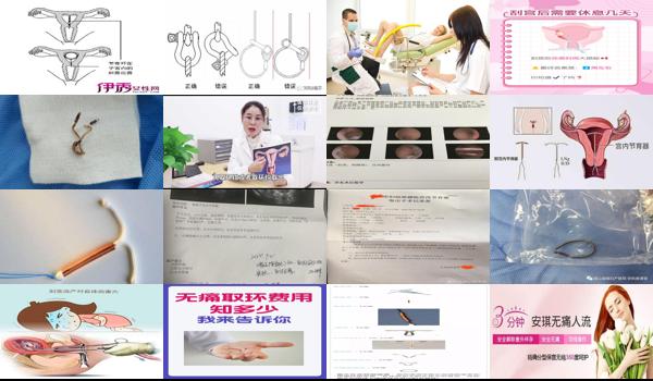 *取环和刮宫多少钱 - 汕头*取环和刮宫伤身体吗