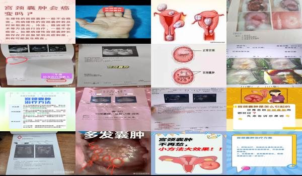 宫颈*的费用是多少钱 - 汕头宫颈*图片和治疗