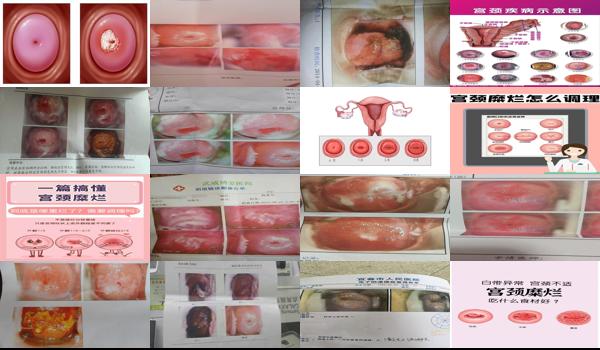 女生宫颈轻度糜烂有无男性方面原因 - 汕头女生轻度宫颈糜烂图片