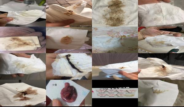 上环后分泌物褐色要几天才干净 - 汕头上环后白带多褐色