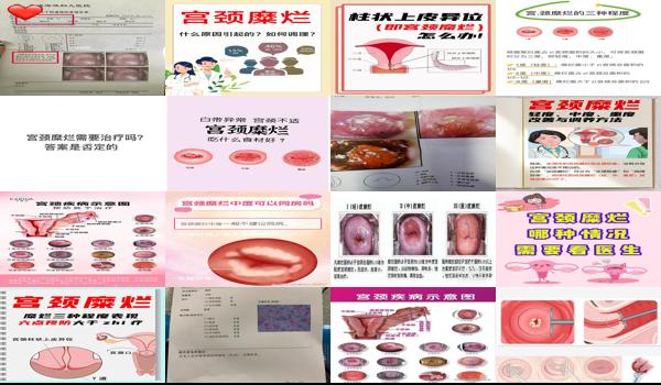 汕头哪个医院治疗宫颈*好 - 汕头重度宫颈糜烂该怎么治疗
