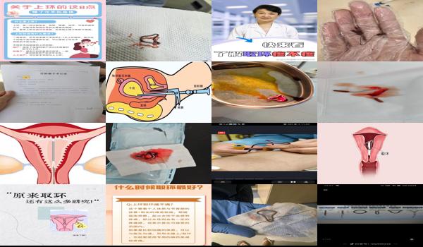 汕头取环去哪个医院好 - 汕头上环取环哪个疼