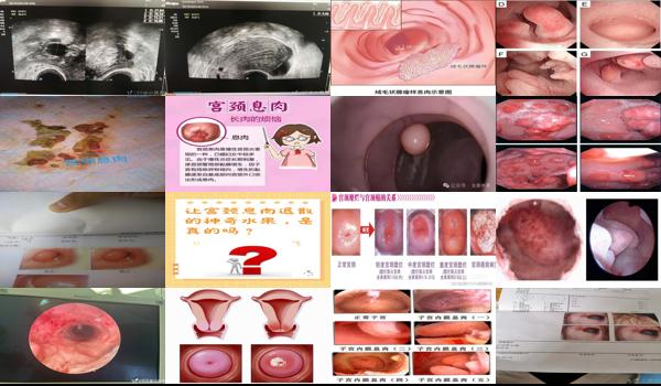 宫颈管里长息肉严重吗,怎么摘除 - 汕头宫颈管里面长的有息肉图片