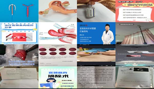 摘除宫颈息肉多久可以怀孕 - 汕头摘除宫颈息肉要多久才可以上环