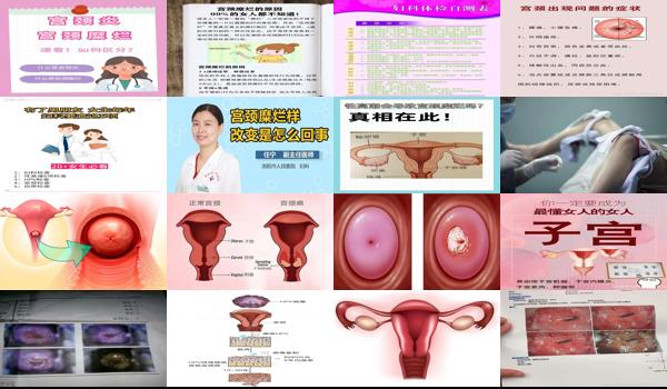 很多女性都有宫颈糜烂吗 - 汕头每个女人都有宫颈糜烂吗