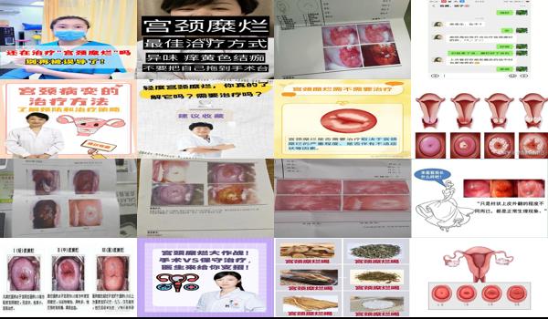 汕头哪个医院治疗宫颈癌好 - 汕头宫颈糜烂需要做治疗么